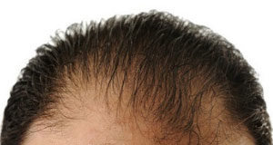 Jakie tabletki na wypadanie włosów wybrać