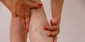 Zalecenia dotyczące profilaktyki żylaków w ciepłe dni