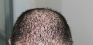 Szybki i skuteczny sposób na łysienie